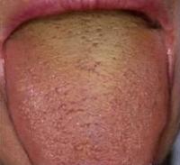 bouche pateuse langue blanche