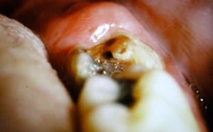 hygiène dentaire dent pourrie