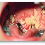 infection de la bouche candida