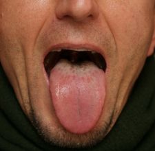 langue blanche causes et mauvaise haleine