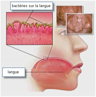 langue chargée cause et bactéries anaérobies
