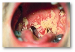 maladie de la bouche candida albicans
