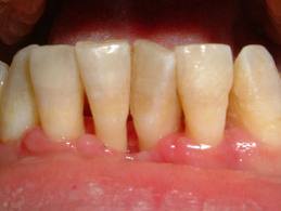 parodontite traitement