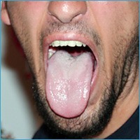 langue tong couche maladie adem slechte