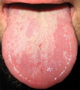 mycose sur la langue