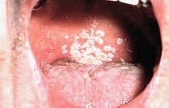 mycose langue traitement